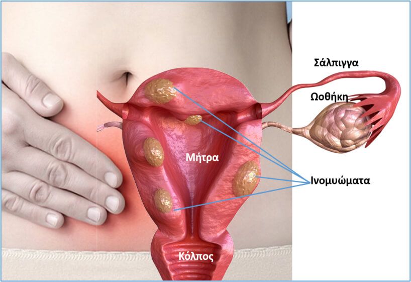 ινομυώματα μήτρας και κύηση